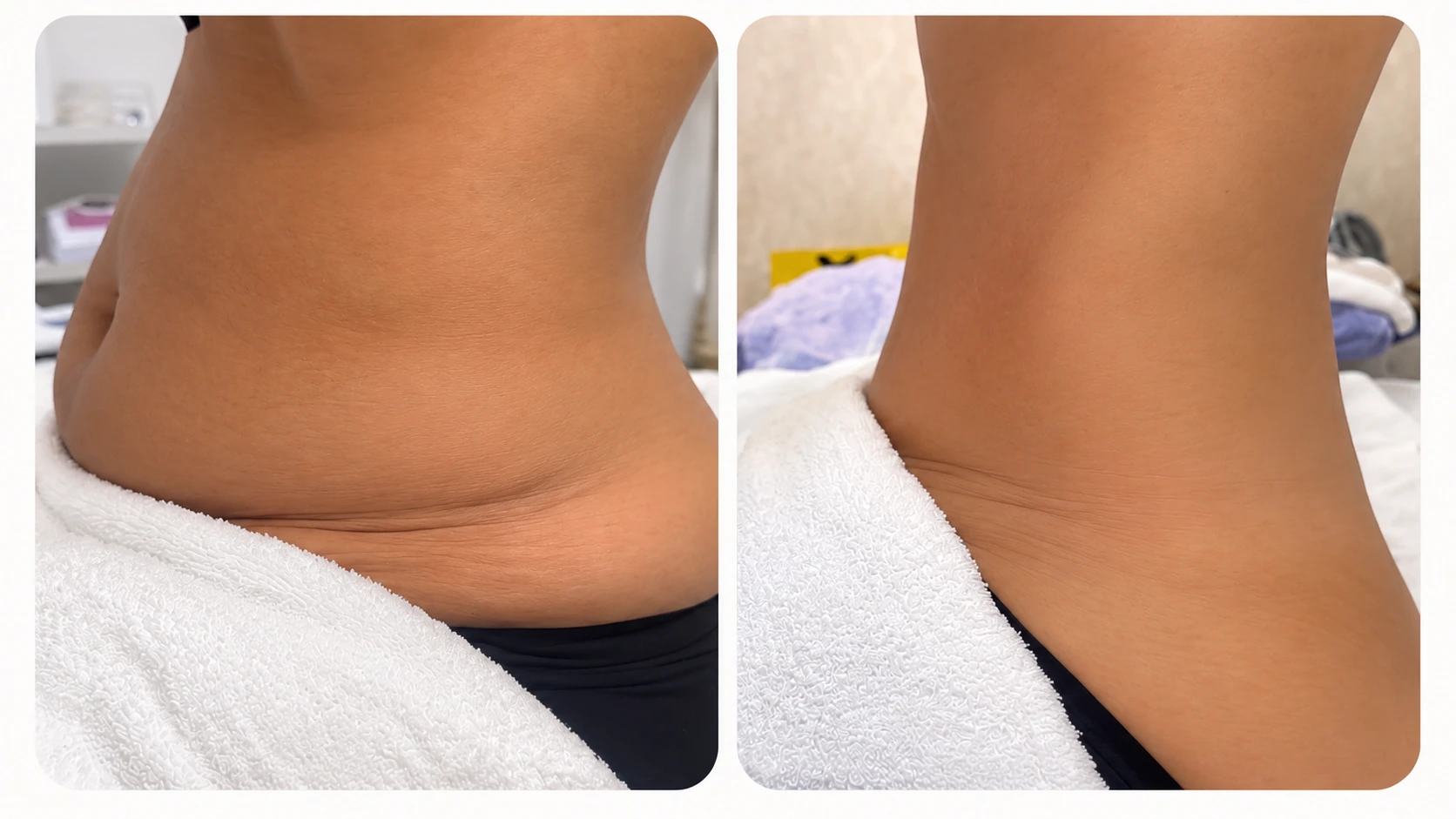 Resultado de Criolipólise: antes e depois