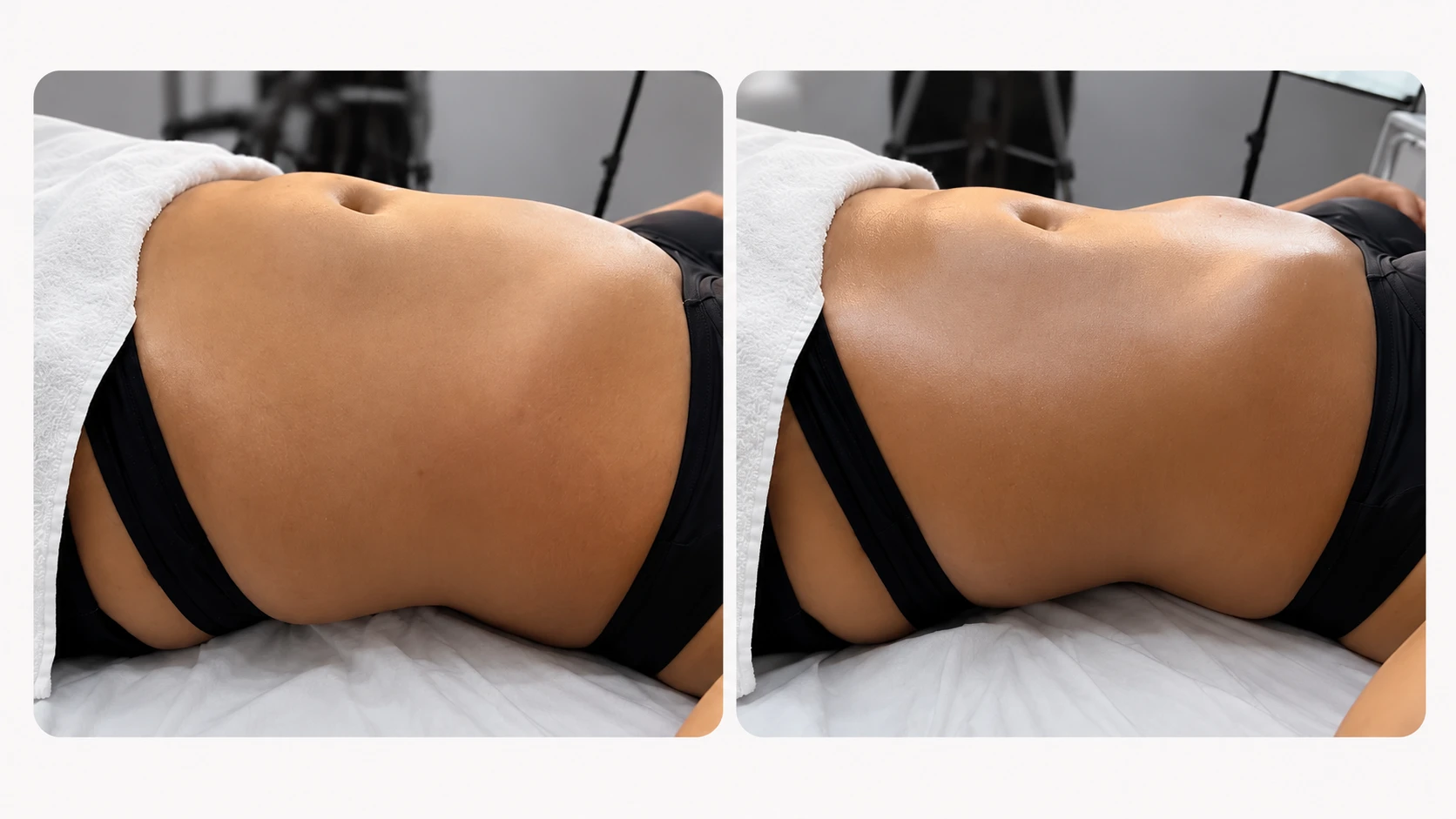 Resultado de Liporedutora: antes e depois
